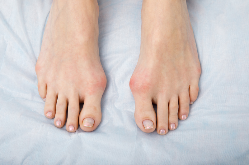 Füße mit dem Hallux Valgus Syndrom